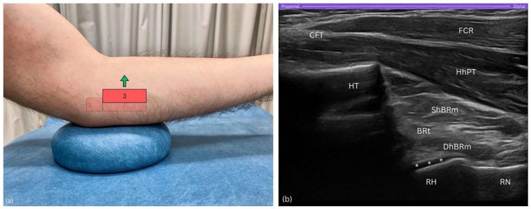 Tendon distal biceps 5 2 Tempo Formacion Ecografia.jpg